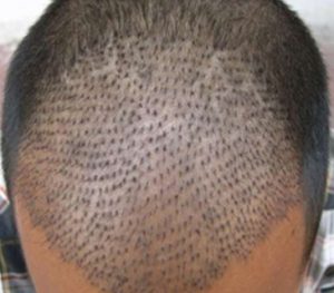 hair transplant